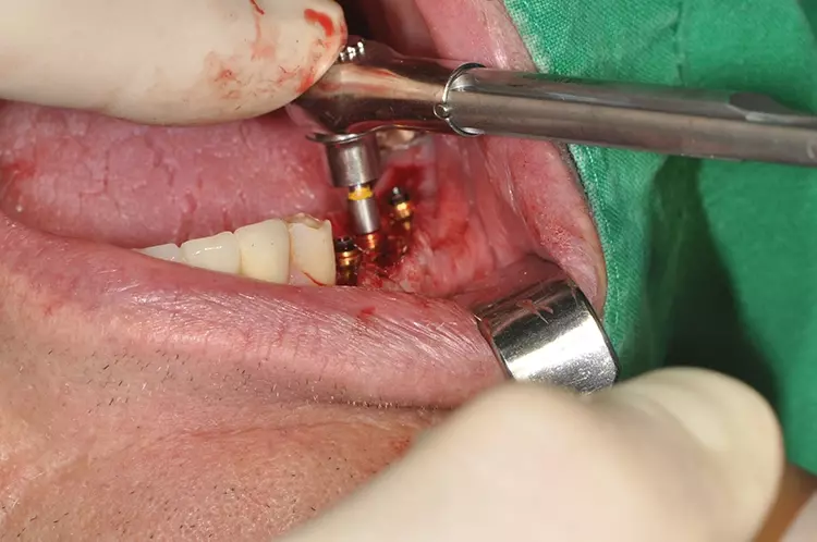 Abb. 5: Endgültiges Einbringen der MultiUnit Abutments
mit Drehmomentratsche während OP-Situs.
