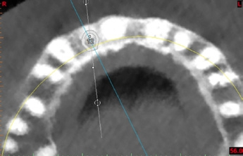 Abb. 6: Leicht nach palatinal geplantes Implantat hinter die gedachte Verbindungslinie über die Labialflächen der Nachbarzähne.