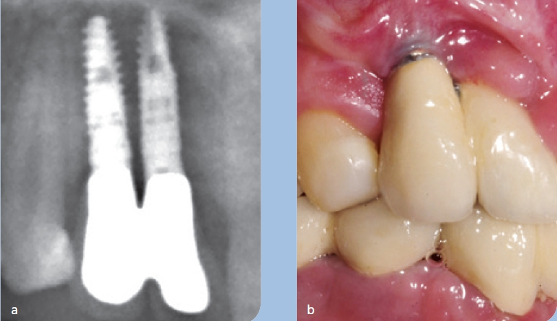 Abb. 5 a u. b: Zu geringer Implantatabstand bei 12,13 bei Nichtanlage (a). Prothetisch, hygienisch und ästhetisch kompromissbehaftetes Ergebnis (b).