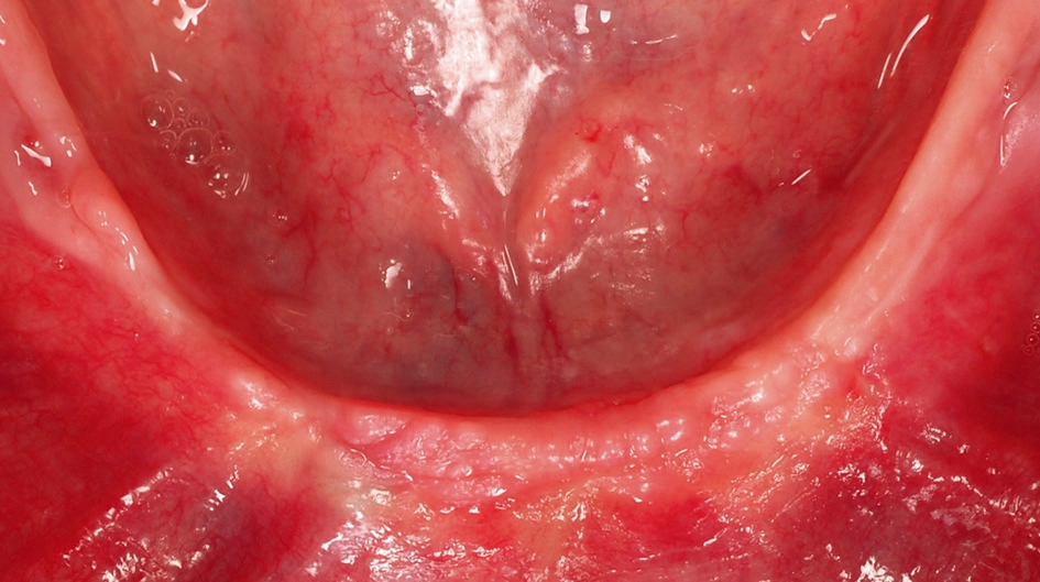 Abb. 6: Komplikationslose Heilung der Implantate 2 Monate nach Implantatinsertion.