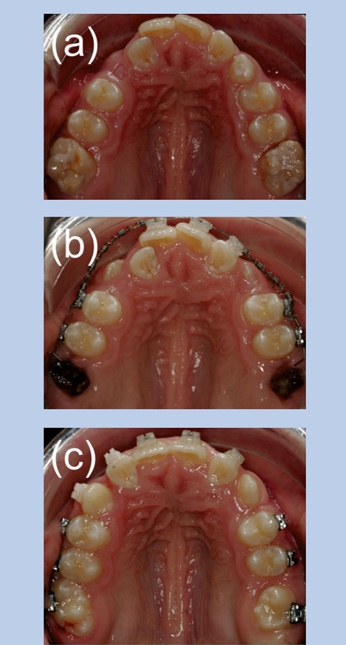 Abb. 5: Kieferorthopädische Therapie von MIH. (a) Aufgrund der allgemeinen Dysgnathie wäre eine kieferorthopädische Behandlung unabhängig von dem Befund MIH angezeigt. (b) Aufgrund des Schweregrades und der eingeschränkten Prognose der MIHMolaren wurden eine Extraktionstherapie eingeleitet und die zweiten Molaren (c) eingeordnet.