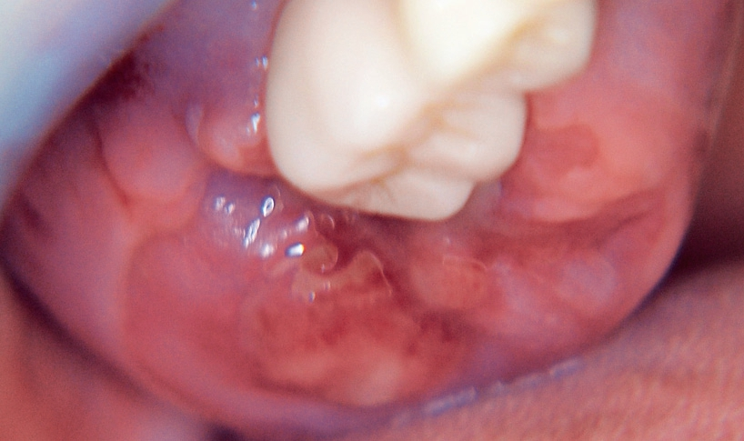 Abb. 4: Massive Schleimhauthyperplasie im Bereich des Tuber maxillae aufgrund eines malignen Lymphoms.