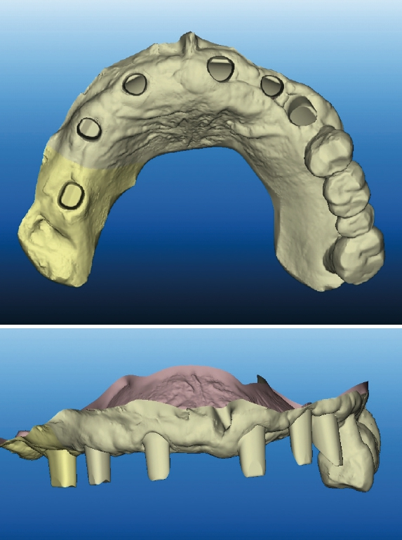 Abb. 5a u. b: Auch komplexe Implantatfälle lassen sich mit dem Startpunkt Intraoralscanner lösen.