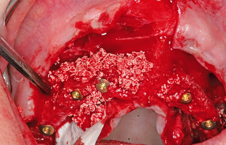 Abb. 5: Augmentation des Osteotomiespaltes nach Implantatinsertion (narrow Sky, Bredent Medical, Senden) und lateraler Augmentation mit biphasischem Knochenersatzmaterial und Membrantechnik.
