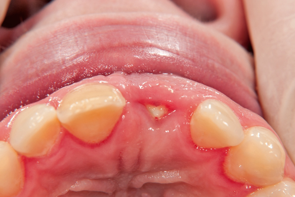 Abb. 5: 3 Monate nach Implantatinsertion.