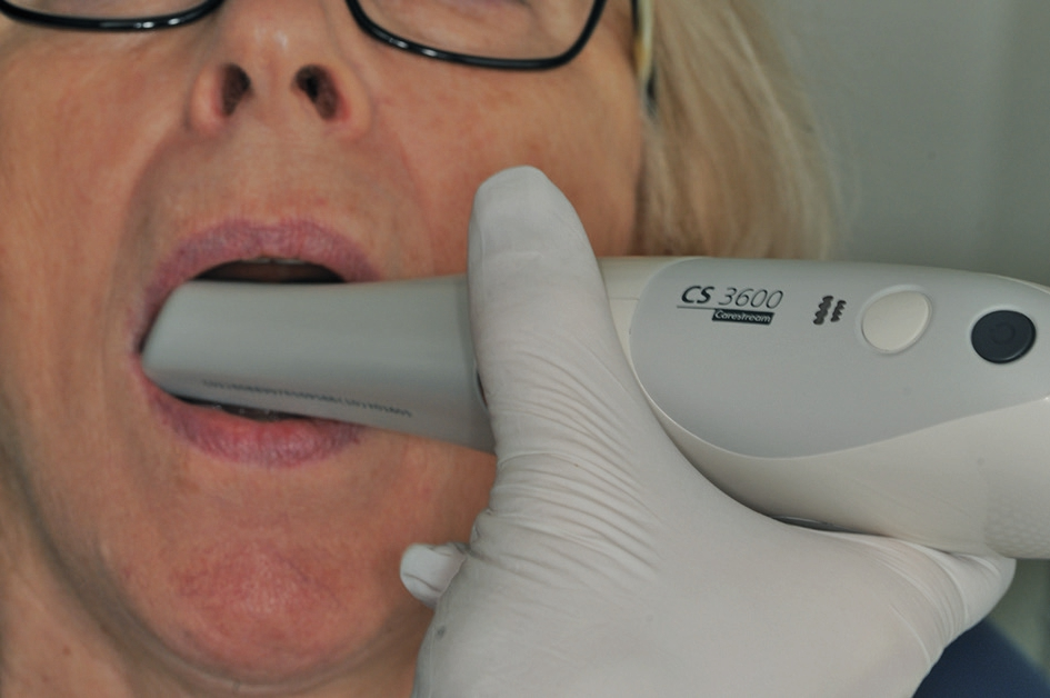 Abb. 5a: Der Intraoralscanner in der Anwendung, ohne Puder oder Flüssigkeit.