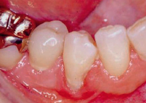 Abb. 3: Gingivitis an angrenzender Klasse-V-Kompositfüllung, wahrscheinlich bedingt durch vermehrte Auflagerung von vitaler Plaque [51]. Aus: G. Schmalz, D. Arenholt-Bindslev: Biocompatibility of Dental Materials, Springer, Heidelberg, 2009.