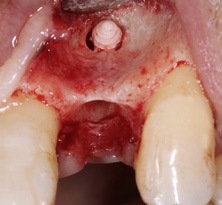 Abb. 5: Durch einen minimalinvasiven apikalen Zugang konnte der frakturierte Implantatrest entfernt werden. Nach der Lappenpräparation zeigte sich der ausgeprägte konkave Kieferkamm.