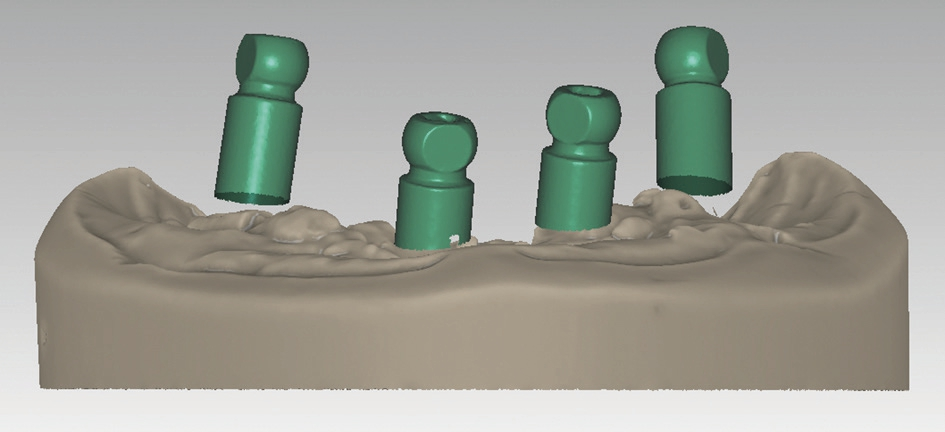 Abb. 8: Digitale Implantatposition anhand von Scanbodys.