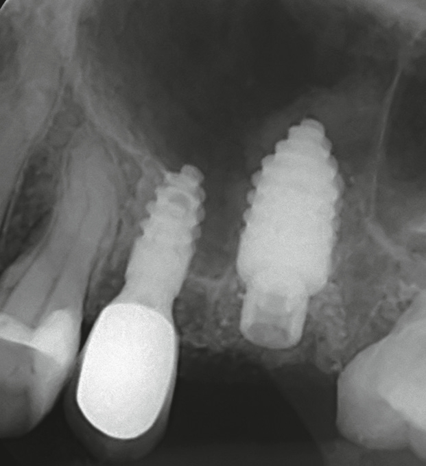 Abb. 5: Das Champions® (R)Evolution-Implantat, Durchmesser 5,5 mm, Länge 10 mm sowie das Augmentat (Dentinpartikel), welches die Extraktionsalveole ausfüllt; post implantationem.