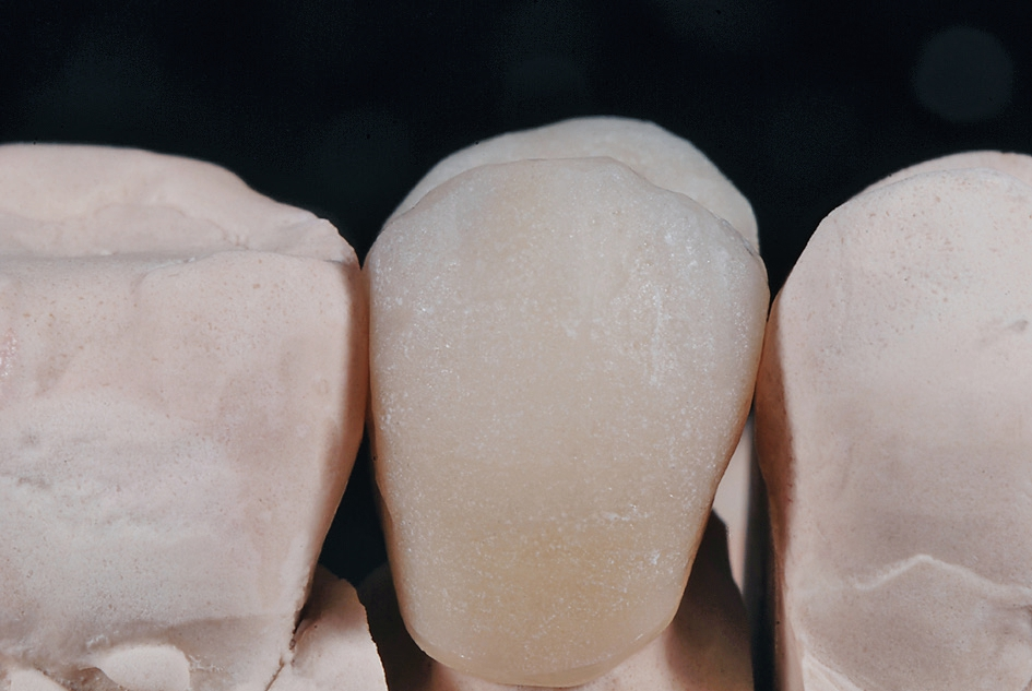 [5] Nach dem zweiten Dentinbrand überarbeite ich die gesamte Oberfl äche der Restauration. Ich stelle Kontaktpunkte und Okklusion etwas strammer ein; so kann ich nach dem Glanzbrand eine Feineinstellung mit dem Polierrad vornehmen.