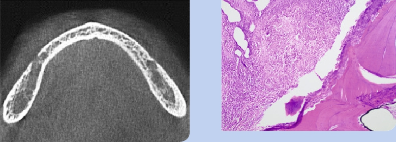 Abb. 7 u. 8: Axiale Ansicht DVT, ROI, histologischer Befund.