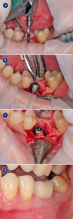 Abb. 4: Klinische Bilder von Patient 15. Implantation erfolgte in regio 36 mit festsitzender prothetischer Versorgung. a) Implantatbohrung nach Extraktion von Zahn 36. b und c) Implantatinsertion d) Zum Zeitpunkt der Zwei-Jahres-Nachuntersuchung.