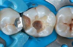 Abb. 5: Approximale Abgrenzung der Kavität mit einem Teilmatrizensystem.