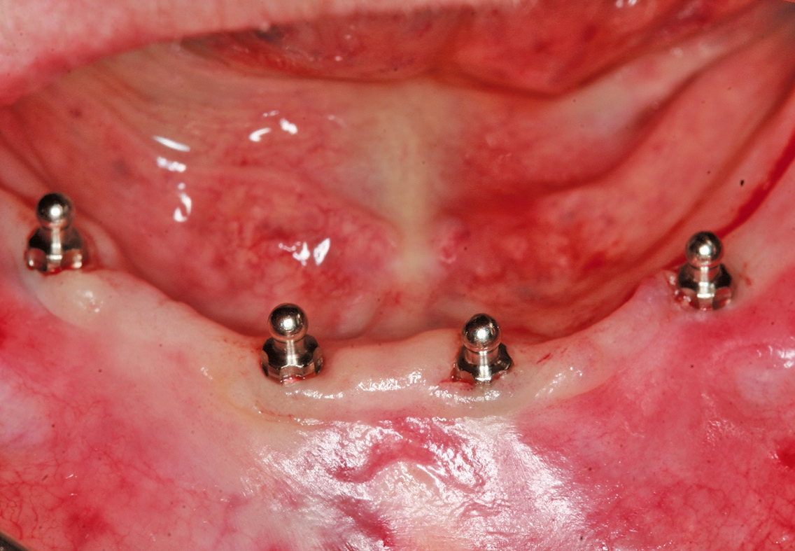 Abb. 5: Alle einteiligen CITO mini®-Implantate mit Kugelkopf (Patrizen) sind atraumatisch inseriert worden.