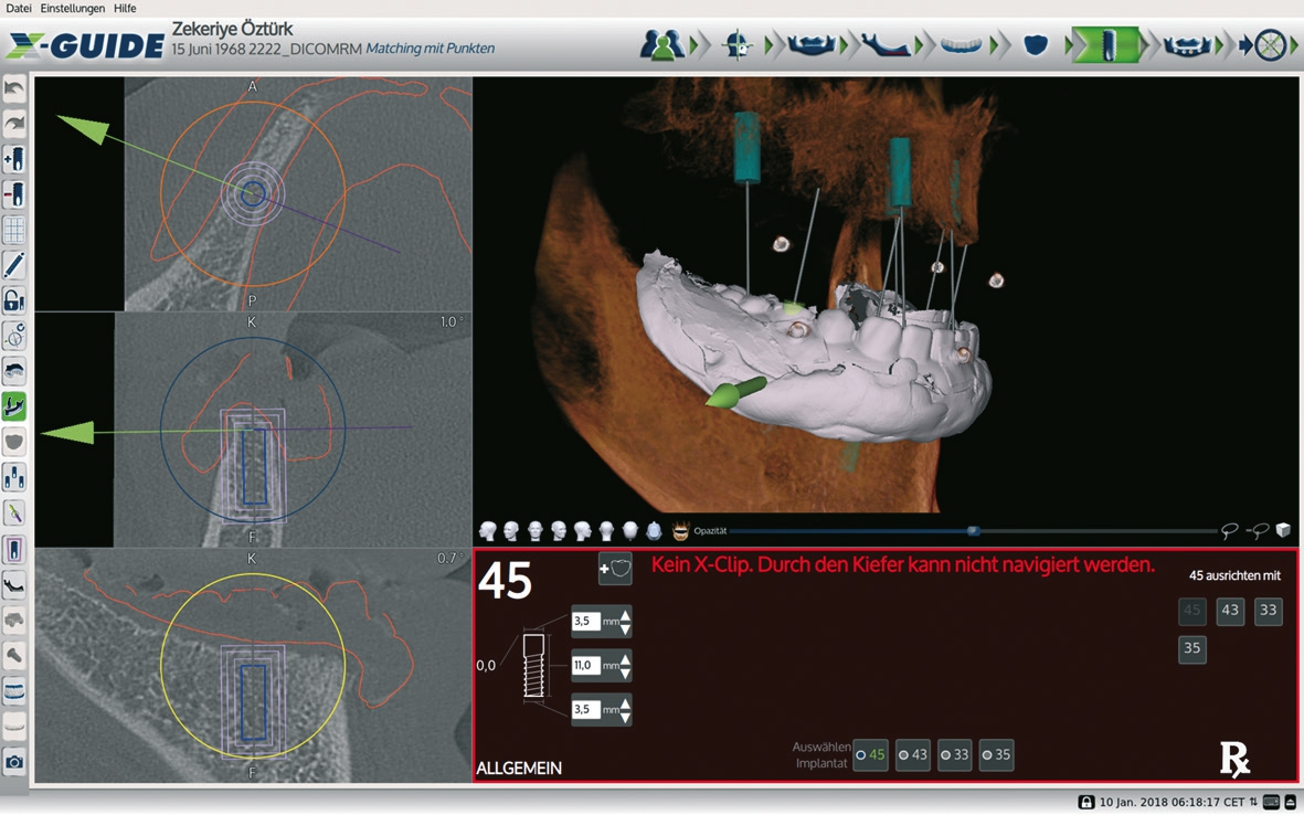 Abb. 5: Implantat regio 45 hervorgehoben mit eingeblendeter Prothese. Die Implantate sind grün dargestellt, die Prothese grau und die „schwebenden“ Kugeln dienen dem Zusammenfügen der einzelnen Dateien von DVT und STL.