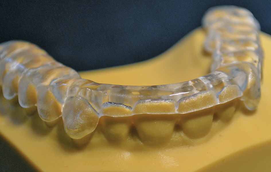 Abb. 3: Aufbissschiene aus dem 3D-Drucker mit 50 ?m Schichtstärke.