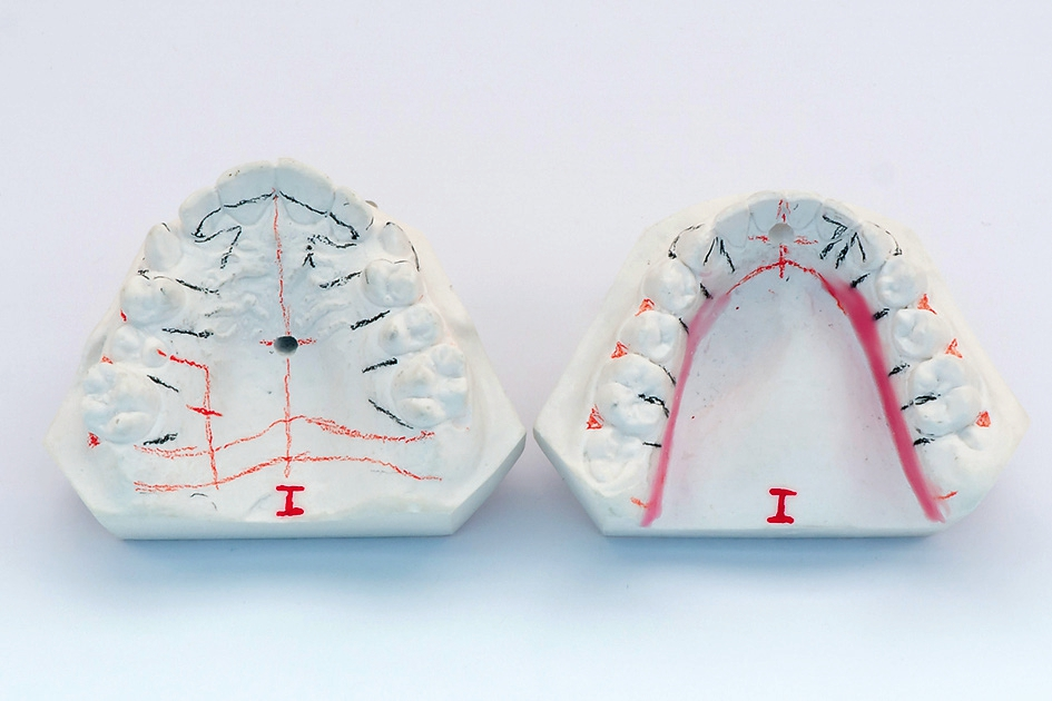 Abb. 42: Ober- und Unterkiefermodelle, interdental radiert und mit angezeichneten Positionen der Drahtelemente.