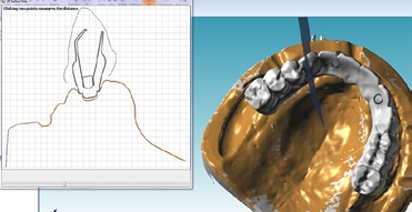 Abb. 7: Schnittbild und virtuelle Ansicht für abgewinkelten Schraubenkanal bei Implantat 13.