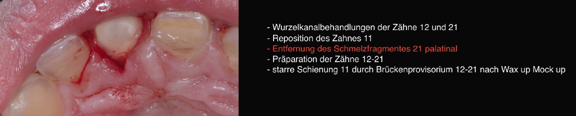 Abb. 7: Entfernung des Schmelzfragmentes Zahn 21.
