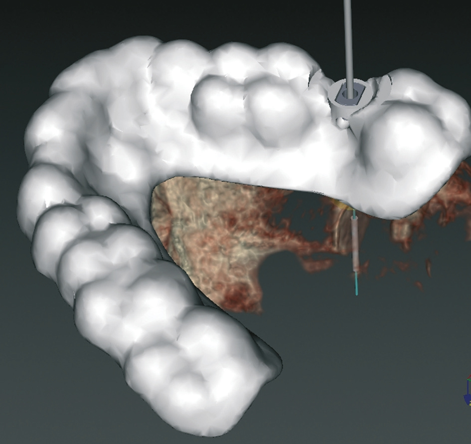 Abb. 4: Aufgrund der oralen Situation konnte die Insertion für ein einteiliges Implantat geplant werden. Die Bohrschablone bietet eine Unterstützung für das Ansteuern der gewünschten Position.