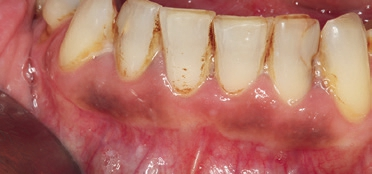 Abb. 5: Bräunliche Läsionen des vestibulären Alveolarfortsatzes im Unterkiefer. Zeichen einer physiologisch vermehrten Einlagerung von Melanin.
