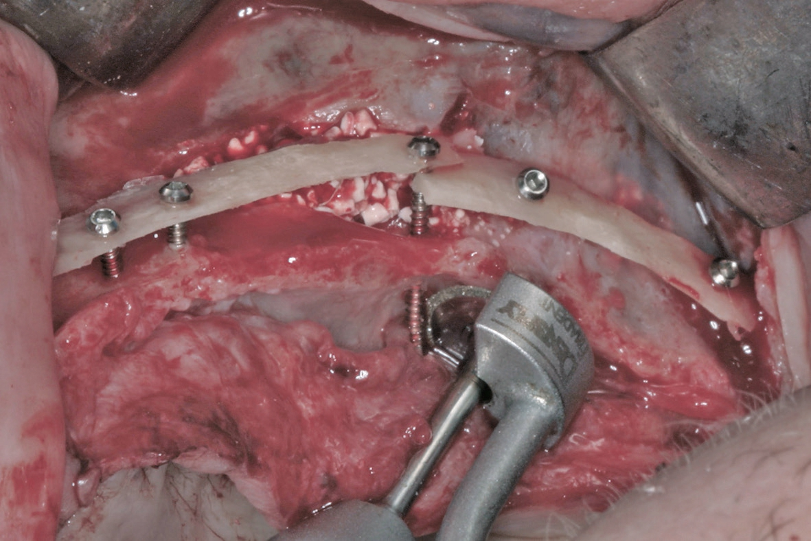 Abb. 5a: Rekonstruktion des Kieferkamms mittels BBA Concept (Biological Bone Augmentation). Palatinal wird eine überstehende Schraube mithilfe der MicroSaw gekürzt.