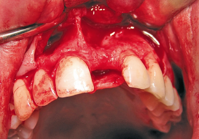 Abb. 3: Intraoperative Situation 12 Jahre nach Zahnverlust.