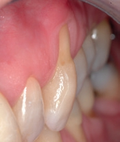 Abb. 5: Mehr breit als tief und zervikal lokalisiert, so laut Definition die klassische Abrasion an einem oberen linken Eckzahn. Oberflächenstruktur und Lichteffekte des Zahnhartsubstanzdefektes lassen auch einen überlagerten erosiven Schaden vermuten.