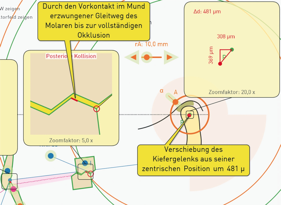 Abb. 5: Auswirkung des Fehlers auf das Kiefergelenk des Patienten: eine Verschiebung um knapp einen halben Millimeter nach anterior!