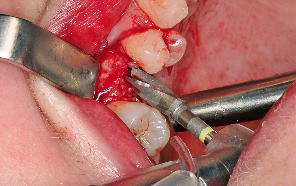 Abb. 5: Mit dem profile.drill wurde das Knochenbett entsprechend dem Implantatdurchmesser ausgeformt.