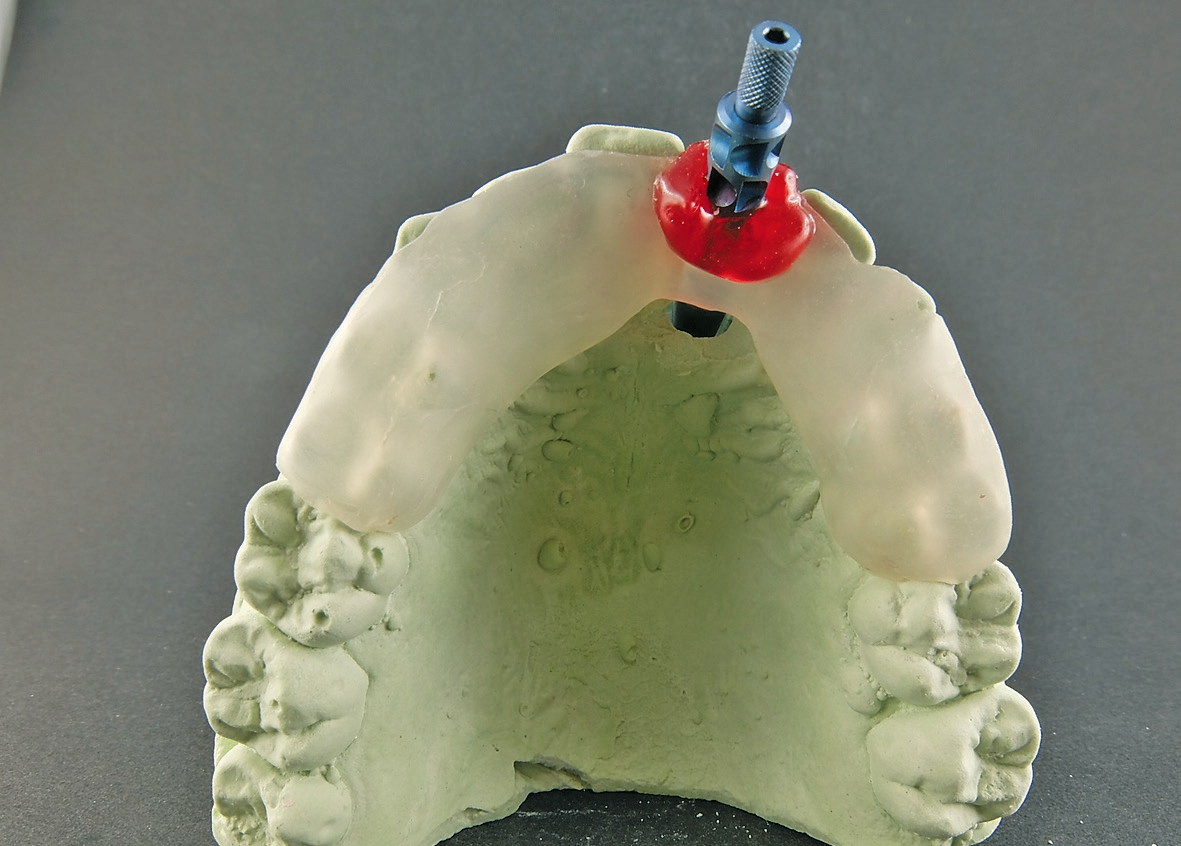 Abb. 13: Übertragungsschiene mit fixiertem Abformpfosten.