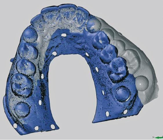 Abb. 5: „Scharniereffekt“ durch Fehlregistrierung beim Ganzkieferscan eines ADA 123 Modells mit einem Intraoralscanner.