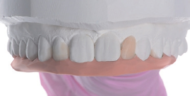Abb. 5: Wax-up nach Digital Smile Design und vorbereiteter Silikonschlüssel.