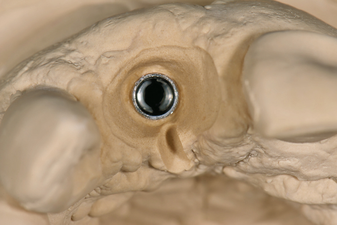 Abb. 5: Radierung der Gingiva auf dem Modell.