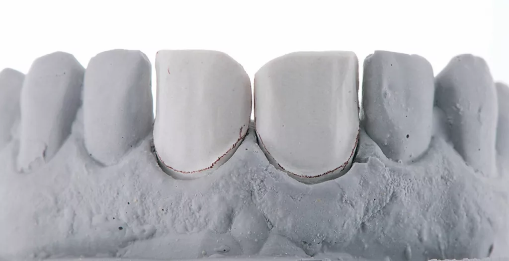 Abb. 5: Geller-Modell mit Einbettmassestümpfen.