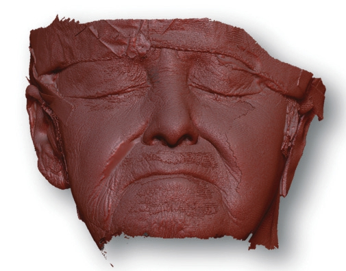 Abb. 5a: Virtuelles 3D-Gesichtsmodell mit Defektdarstellung.