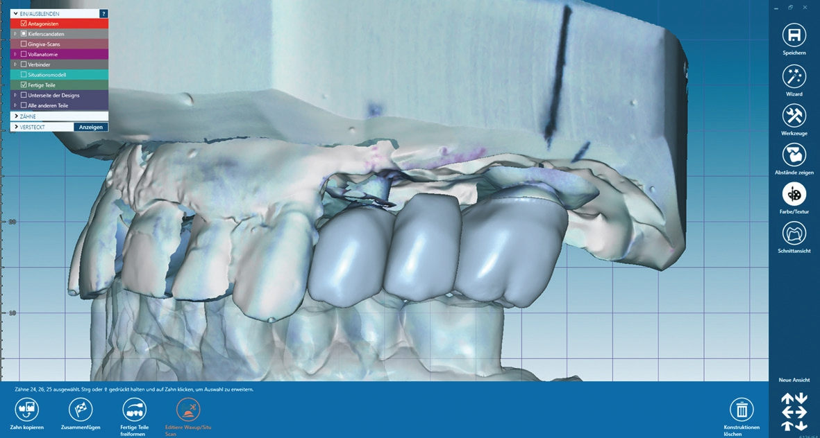 Abb. 5: Wax-up als Basisdatensatz für das Provisorium.