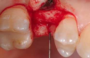 Abb. 5: Di Aufbereitung des Implantatbettes.