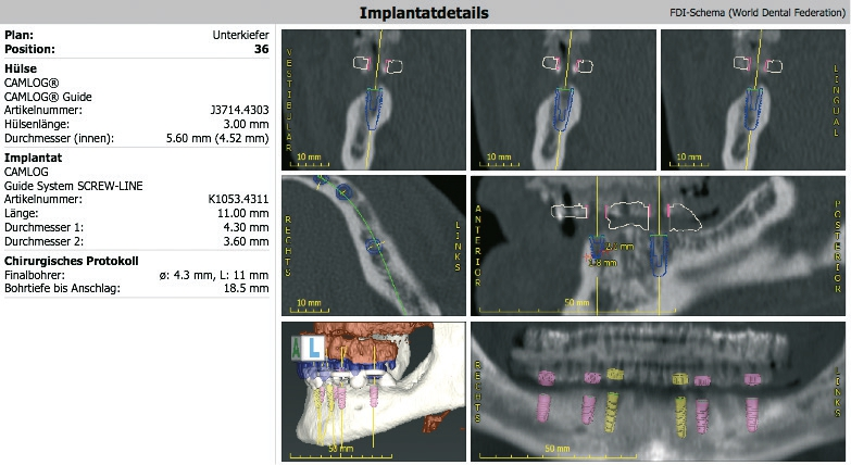 Abb. 5: Screenshot der virtuellen Implantatplanung im Detail.