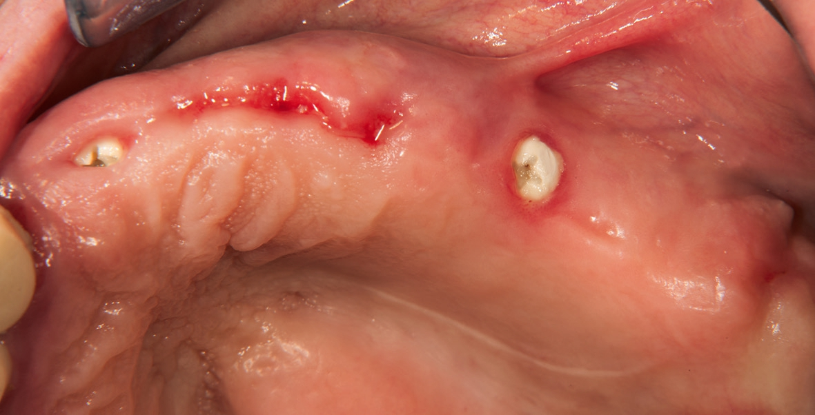 Abb. 5: Nach dreimonatiger Einheilphase, vor dem Freilegen der Implantate.