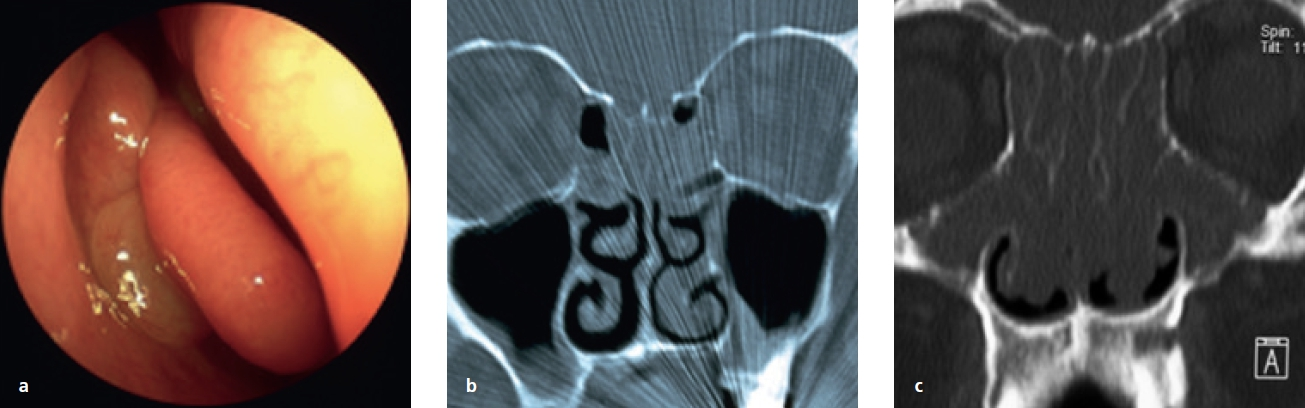 Abb. 4a–c: a) Polyposis nasi im mittleren Nasengang. b) Typisches CT-Bild einer chronischen Rhinosinusitis (CRSsNP). c) CT-Bild einer chronischen Rhinosinusitis mit Polyposis nasi et sinum (CRSwNP).