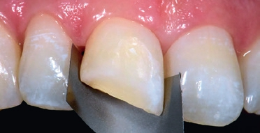 Abb. 5: Zustand nach Abstrahlen mit AL(2)O(3).