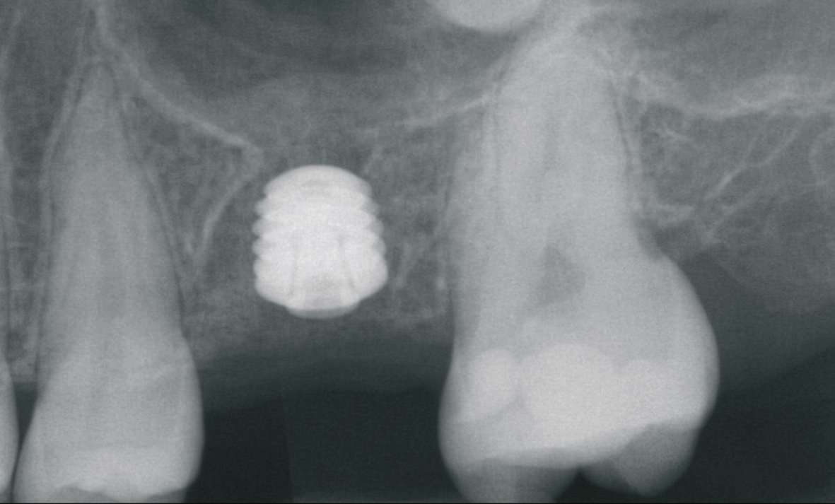 Abb. 5: Röntgenkontrolle der Implantatinsertion mit basaler Einlagerung von Knochenspänen und Knochenersatzmaterial.