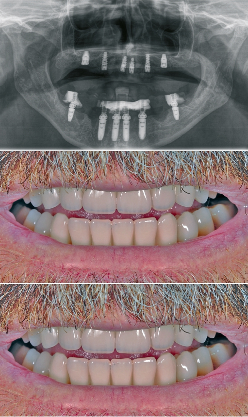 Abb. 8 bis 10: Intraorale Situation post OP: Situation nach Knochenaufbau und Implantation. Oberkiefer = 16, 26 D: 5,0 mm - L 10 mm Nobel parallel; 13, 23 D: 4,3 mm - L 13 mm Nobel active; 11,21 D: 4,3 mm - L 11,5 mm Nobel active; Unterkiefer = 36, 46 D: 5,0 - L 10 mm; 33, 43 D: 4,3 - L 15 mm Nobel parallel; 31,41 D: 3,75 – L 15 mm Nobel parallel. Im Unterkiefer befindet sich die verschraubte Interimsprothese mit Sofortbelastung, im Oberkiefer ist eine ausgeschliffene Totalprothese fixiert. Die unverschraubte Versorgung mittels Totalprothese stellte für den Patienten kein Problem dar, da zu jeder Zeit eine ästhetische Versorgung gewährleistet war. Wichtig ist jedoch, dass die Totalprothese großzügig ausgeschliffen wird, da keinerlei Druck auf das Operationsgebiet ausgeübt werden darf.