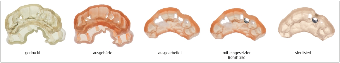 Abb. 5: Farbumschlag einer Chirurgie-Schiene aus dem 3D-Drucker. Vor, nach und während der Herstellung.