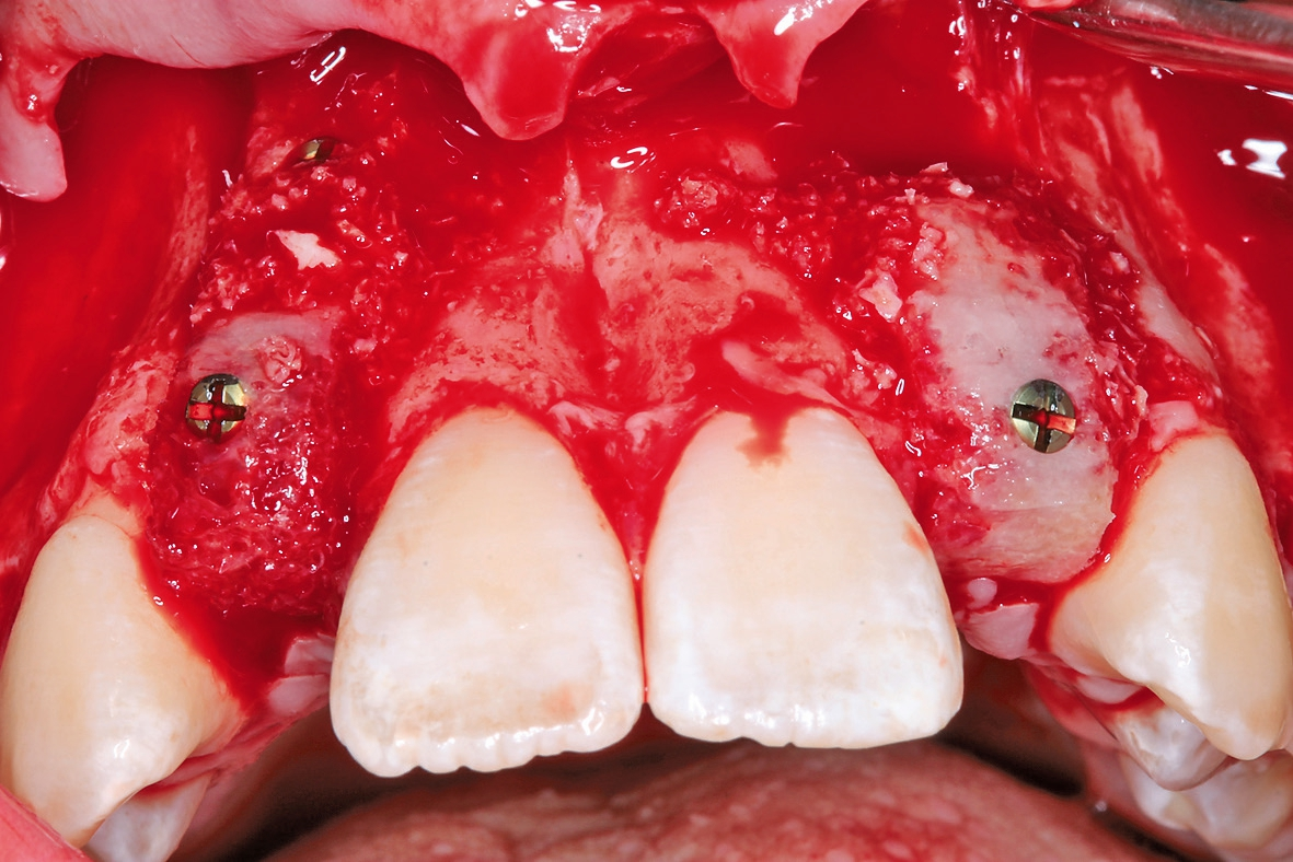 Abb. 6: Fixierung der kortikospongiösen Blöcke mit Osteosyntheseschrauben.