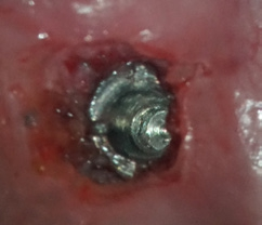 Abb. 8: Unbeschädigte Implantat-Innenverbindung.