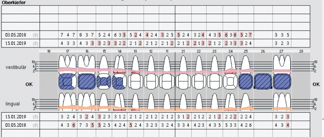 Abb. 5: Gegenüberstellung PA-Status Oberkiefer.