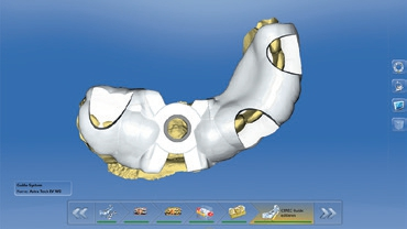 Abb. 5: Design der Bohrschablone in der CEREC SW 4.6.1.